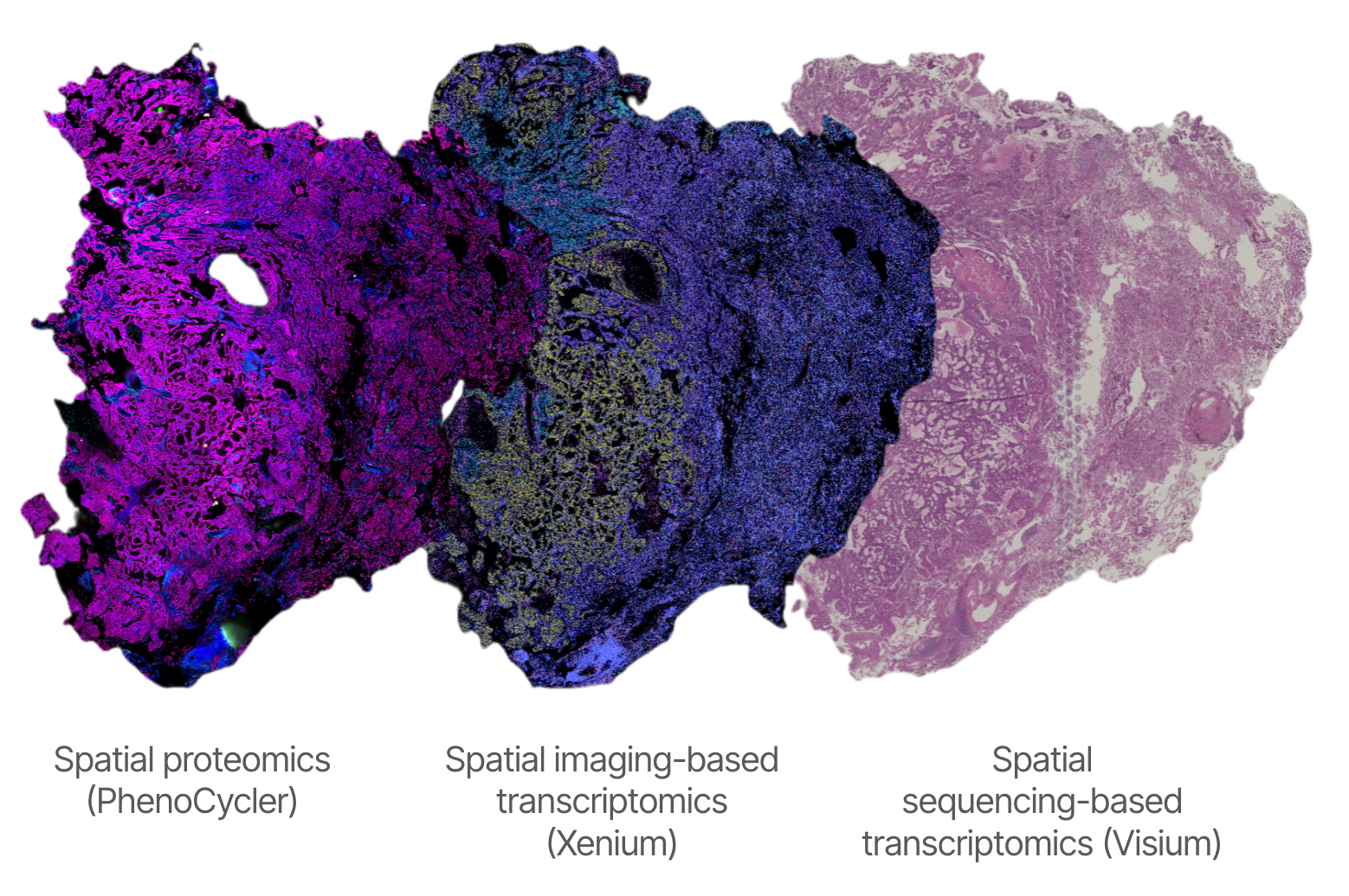 From transcriptional states to spatially validated tumor architecture: a multi-omics view of lung adenocarcinoma thumbnail