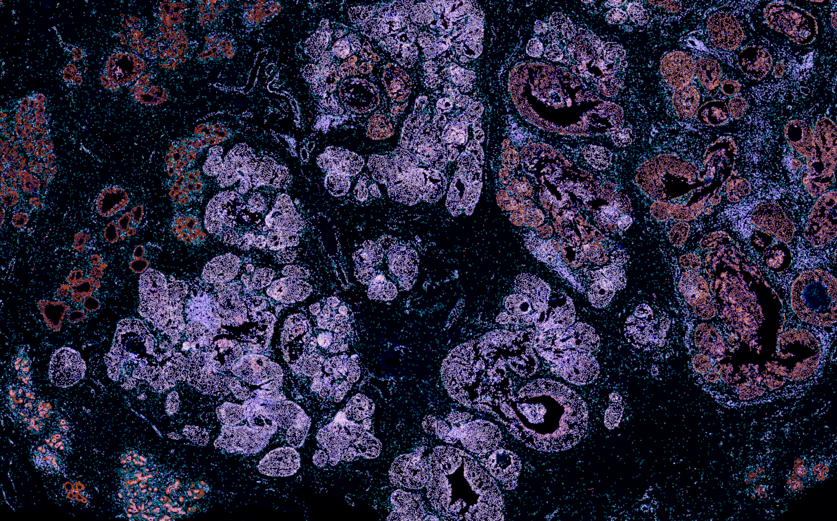 How Whole-Transcriptome Spatial Profiling Reveals Hidden Tumor Heterogeneity in Breast Cancer thumbnail