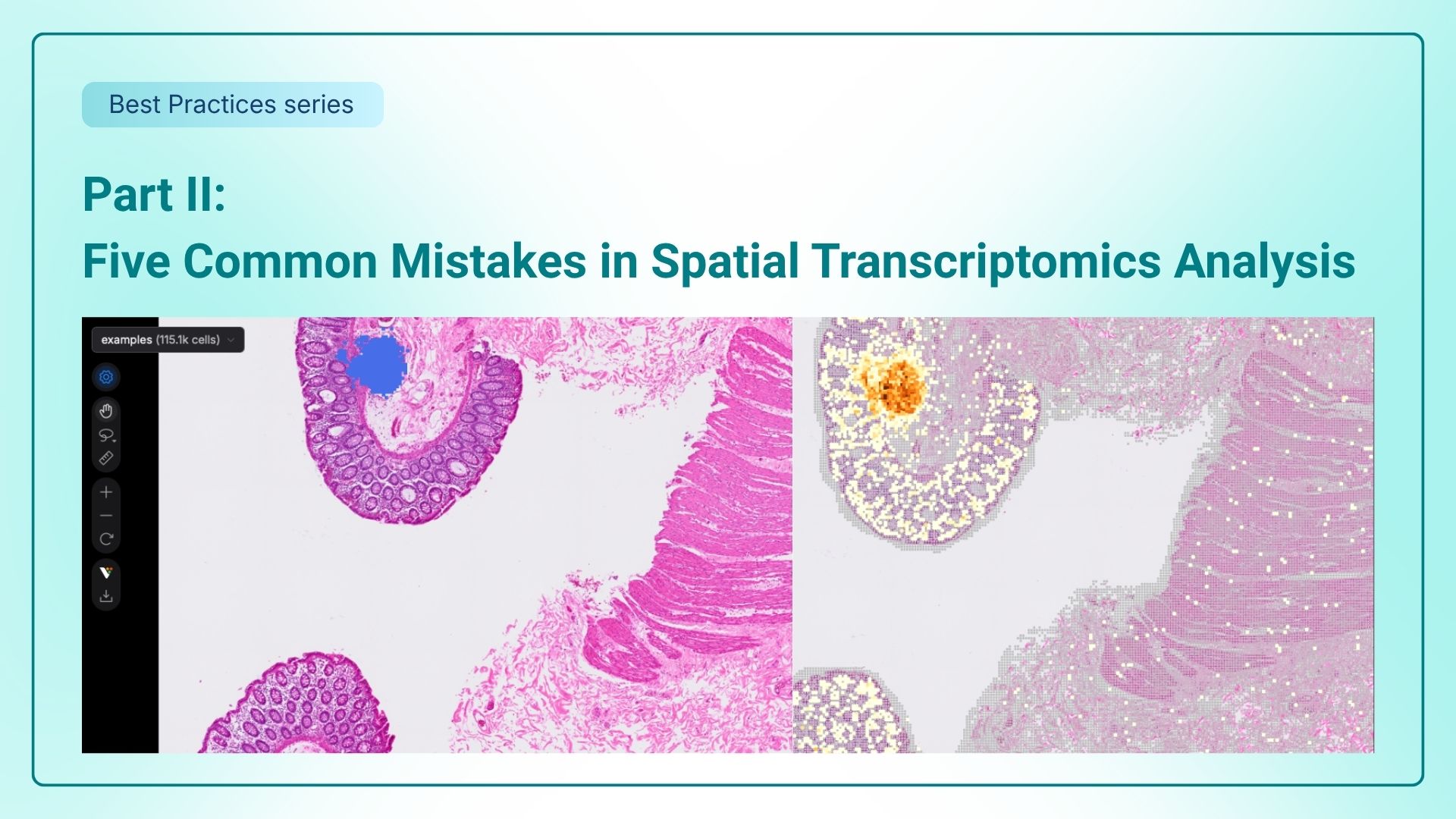Five Common Mistakes in Spatial Transcriptomics Analysis – Part II thumbnail