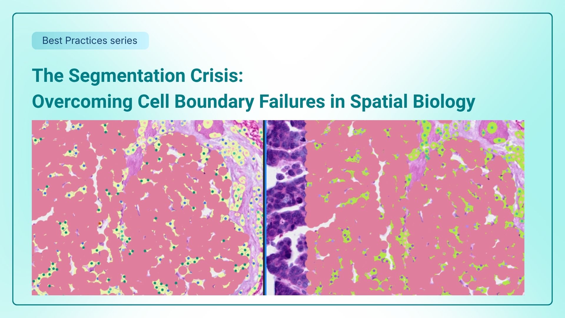The Segmentation Crisis: Overcoming Cell Boundary Failures in Spatial Biology thumbnail